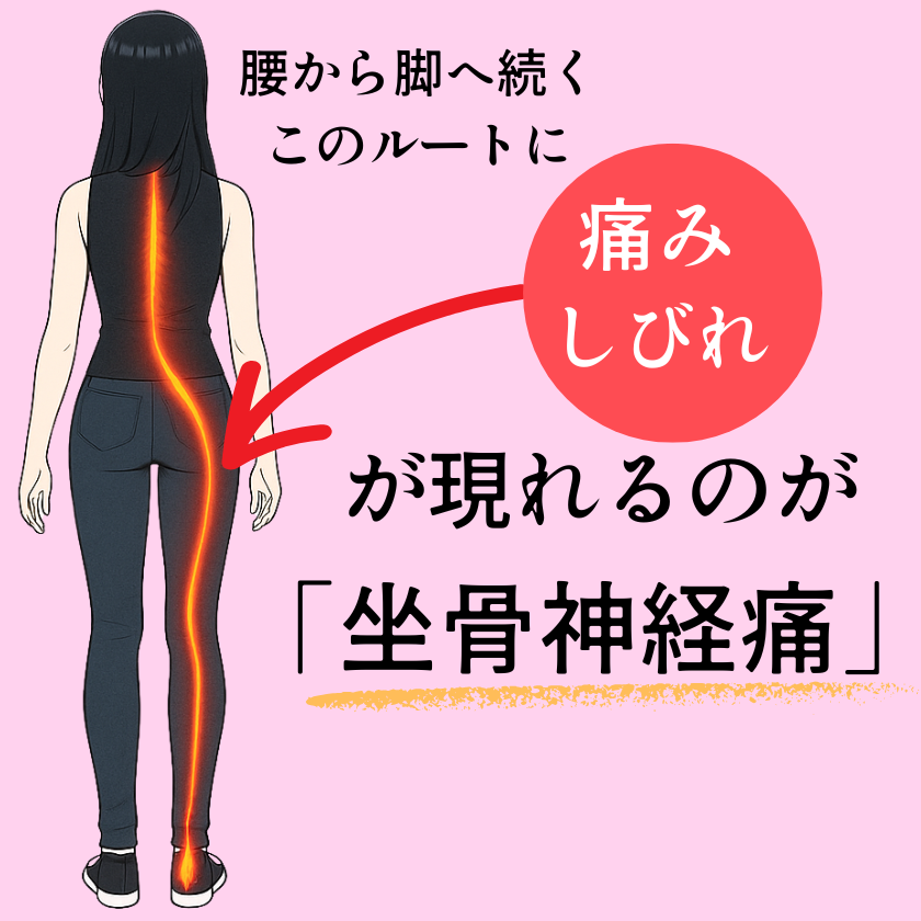 坐骨神経痛の痛みのラインをイラスト化