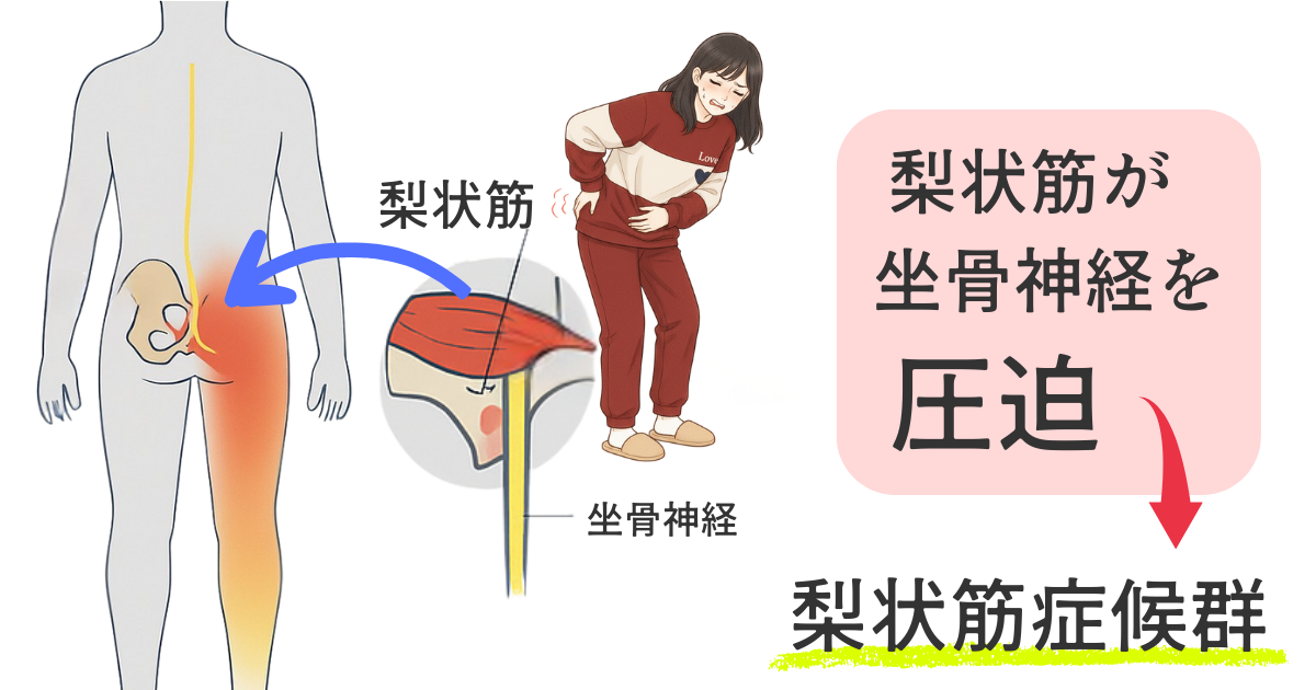 坐骨神経痛の痛みの根っことなる梨状筋の図解イラスト|硬くなった筋肉が神経を圧迫する様子