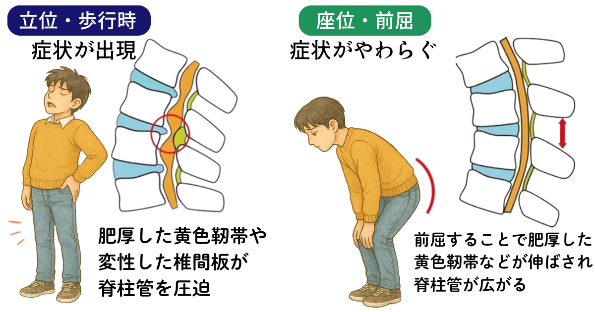 坐骨神経痛の原因となる脊柱管狭窄症の図解イラスト|神経の通り道が狭くなり血流が悪化する様子